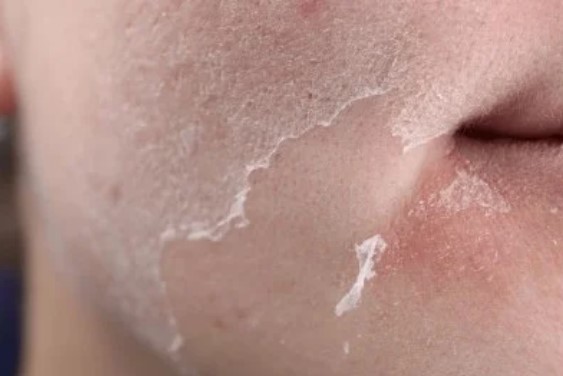Dry Skin in winter season in Punjabi